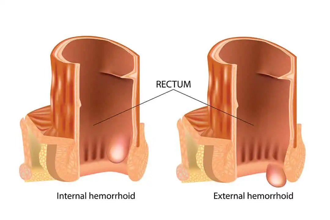 best haemorrhoid cream