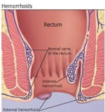 hemorrhoids during pregnancy